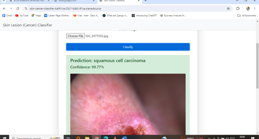 Explainable Machine Vision Techniques for Skin Cancer Detection